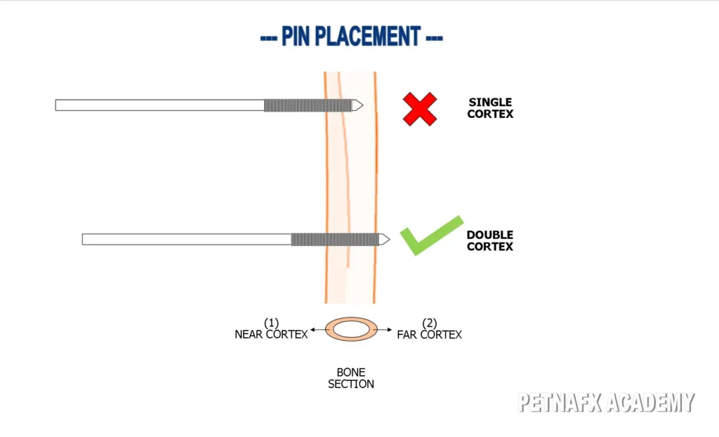 External Fixator Pin Placement Principals